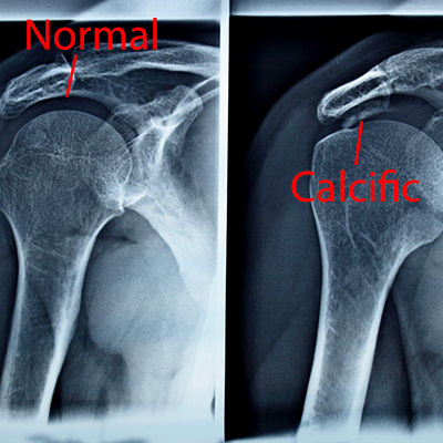 CALCIFIED BURSITIS
